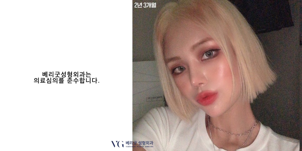 V라인 턱끝성형✌ 윤곽수술도 역시 베리굿성형외과 관련 이미지 5
