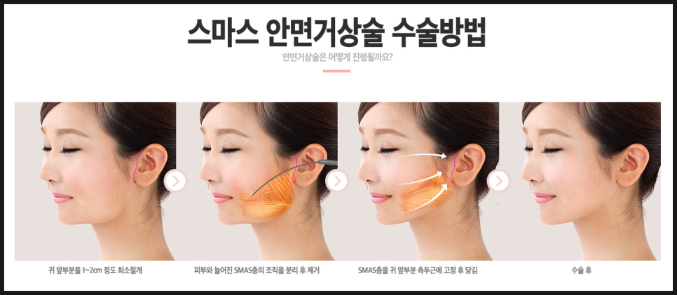 동안미모는 안면거상술 하기전과 하고난후로 나뉜다! 관련 이미지 3