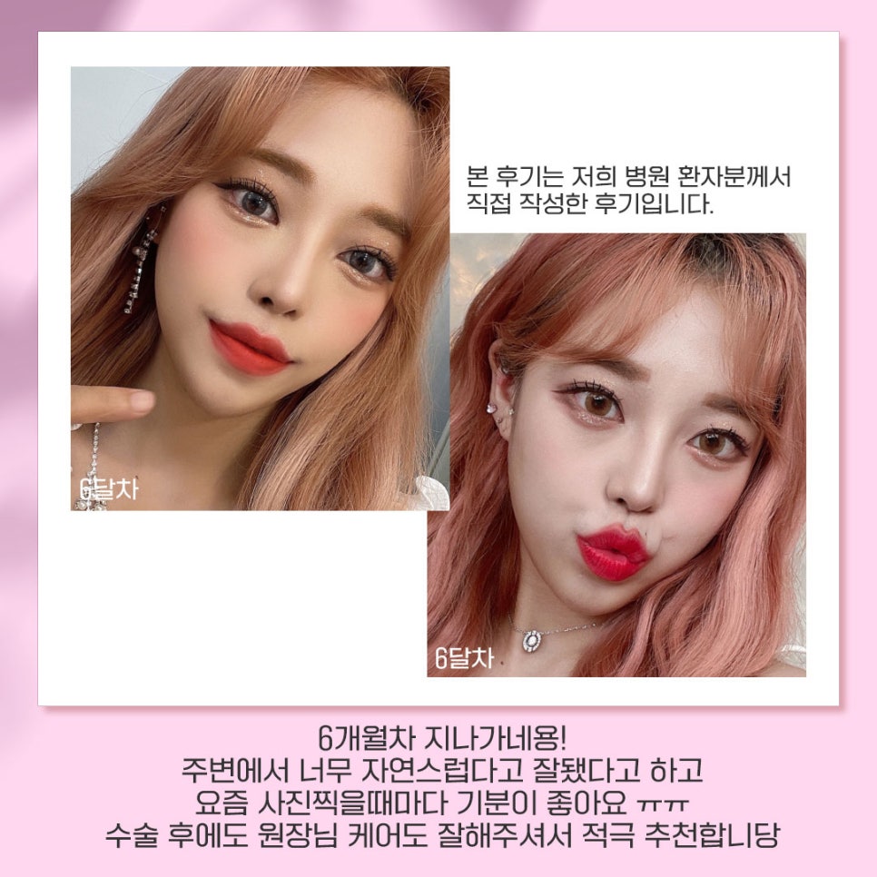 베리굿성형외과가 추천하는 성형별 추천👏 관련 이미지 12