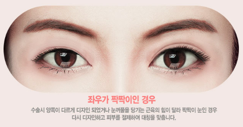 눈재수술, 원인과 상태에 따라 방법도 바뀐다? 관련 이미지 4