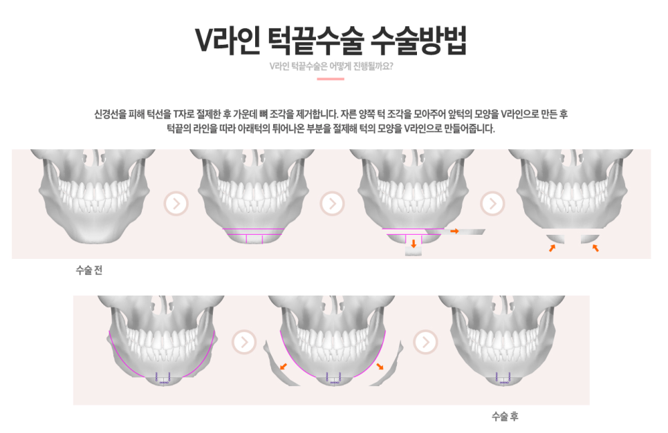 사각턱축소술로 안면 비대칭교정도 가능하다?? 관련 이미지 5