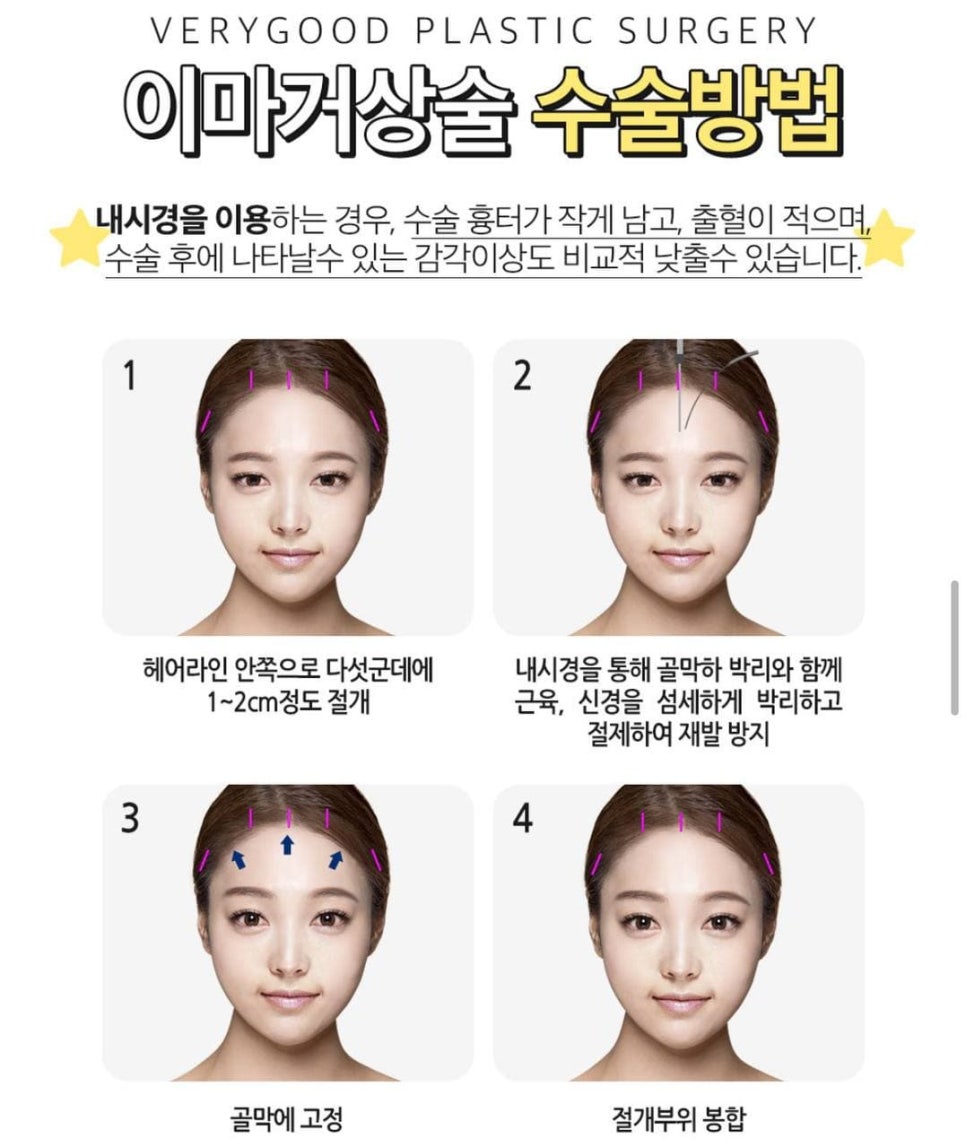 이마거상술 잘하는곳,이마거상술 가격 알아보자 관련 이미지 4