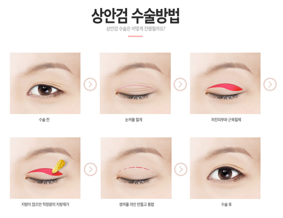 쳐진 눈매를 더 탄력있고 젊게👀💖 베리굿 상안검 관련 이미지 3