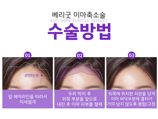 넓은 이마 고민! 이마축소로 해결하자! 관련 이미지 5