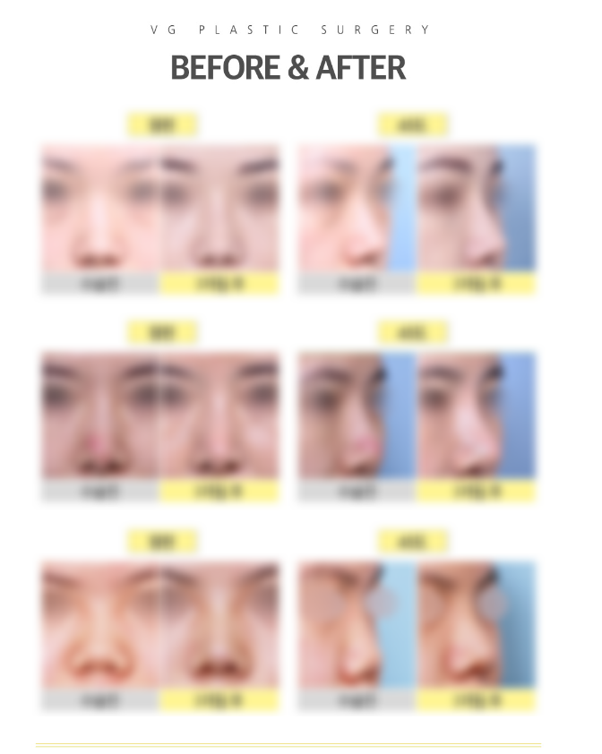 엑설런트코성형으로 콧대높은 자신감 얻자! 관련 이미지 9