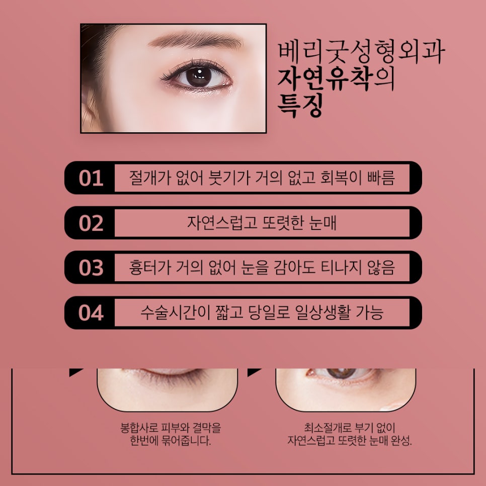 자연유착쌍커풀, 매몰쌍수 후 자연스럽고 또렷한 눈매로 관련 이미지 4