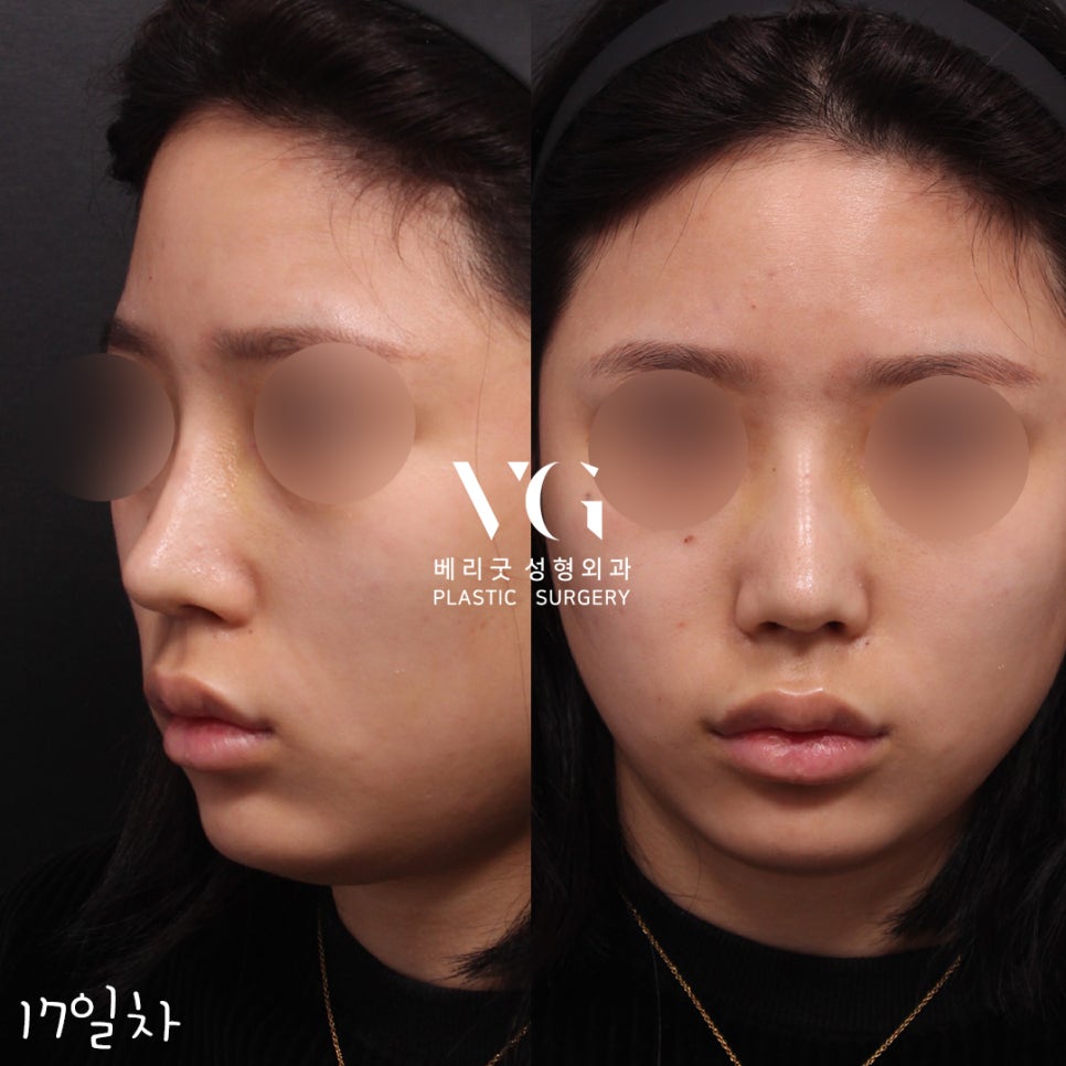직반코성형전후💖베리굿성형외과 관련 이미지 5