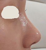 첫코수술 코끝수술 비중격교정술 하비갑개절제술 베리굿성형외과 전후후기 관련 이미지 2