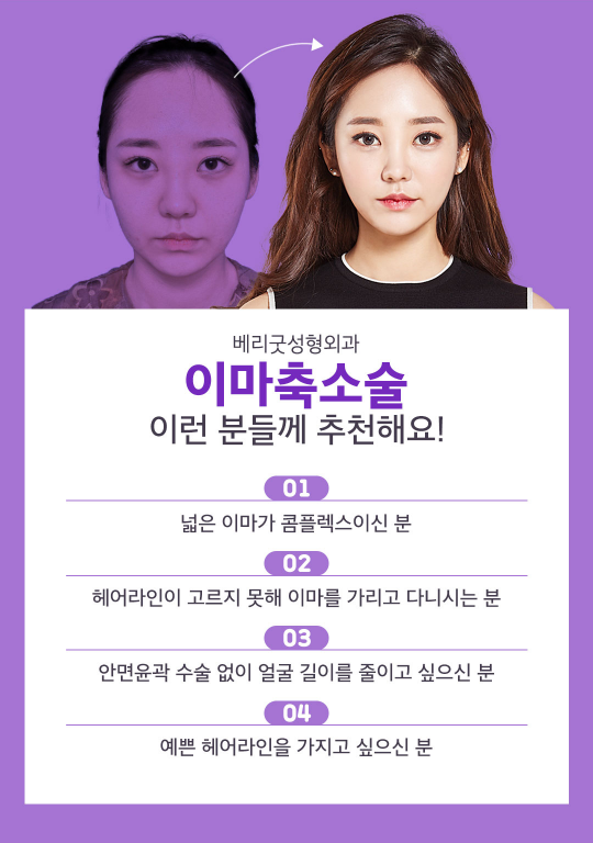 넓은 이마 고민! 이마축소로 해결하자! 관련 이미지 3