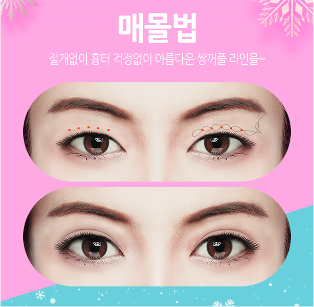 베리굿성형외과 관련 이미지 4