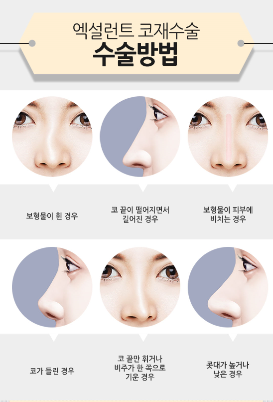코재수술 재수술인 만큼 더 만족스럽게! 관련 이미지 5