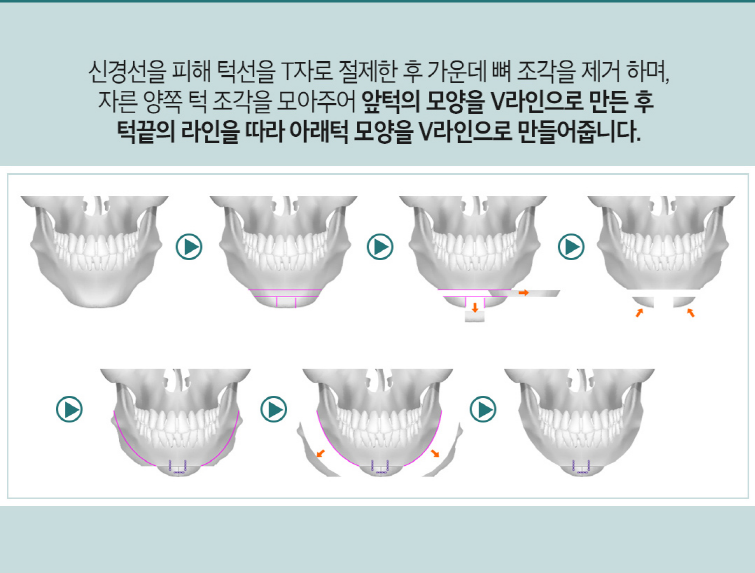 안면윤곽 매끄럽고 아름답게! 관련 이미지 5