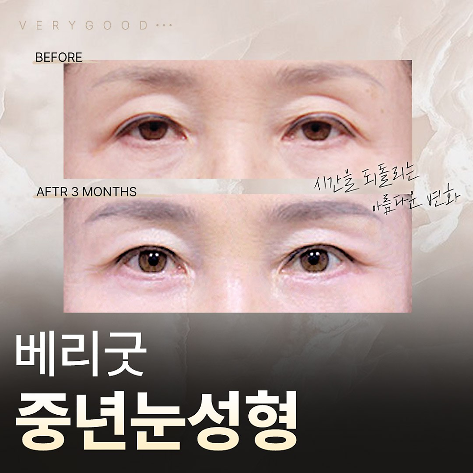 처진 눈꺼풀로 답답한 인상, 강남역 중년 눈성형으로 교정하기 관련 이미지 1