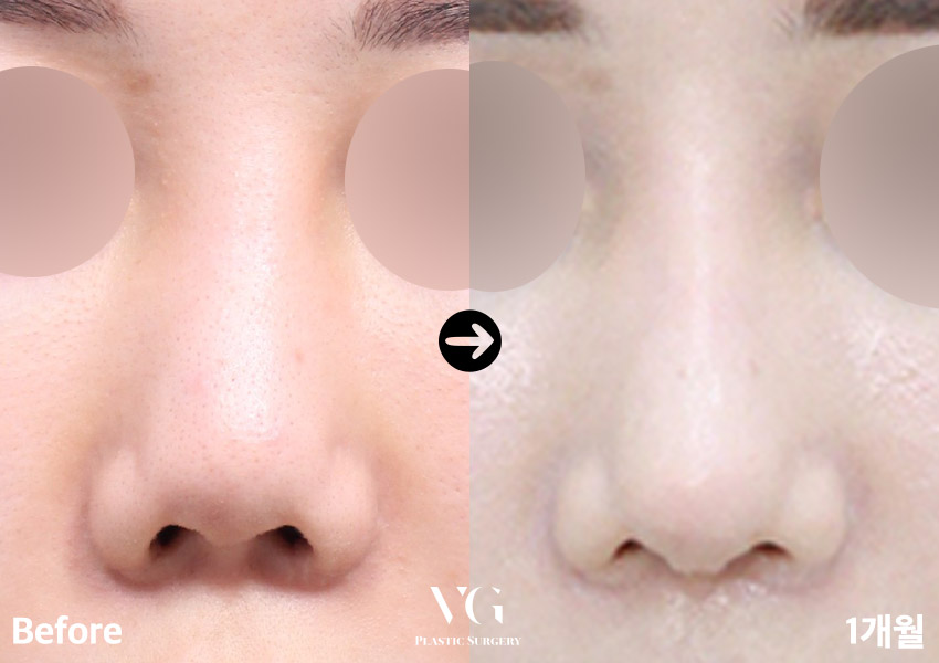 실패한 구축코재수술 베리굿에서 👨&zwj;⚕️✨ 관련 이미지 6