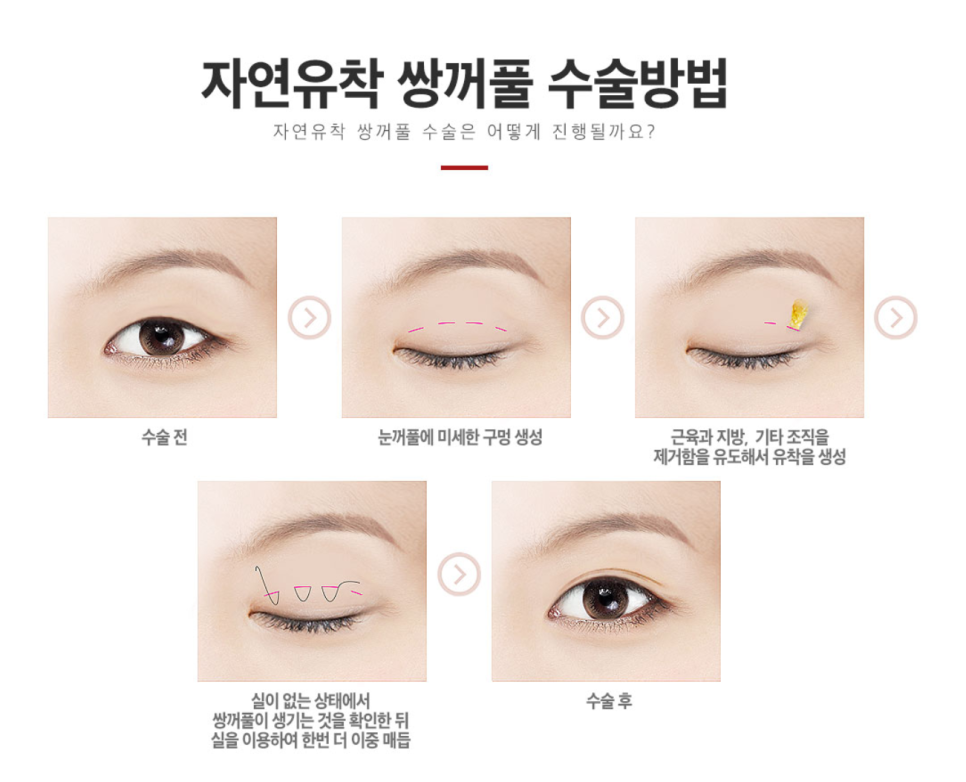강남쌍꺼풀수술성형외과 , 나한테 맞는 수술방법 디자인으로 눈성형 성공하려면 관련 이미지 6