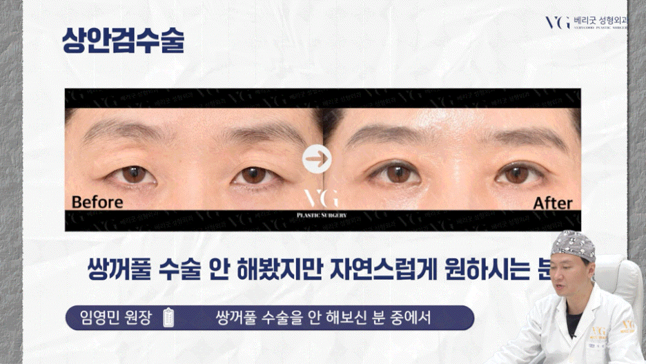 강남중년눈성형 잘하는곳 , 상안검 하안검 눈썹하거상술종류 진행방법 궁금하다면 관련 이미지 37