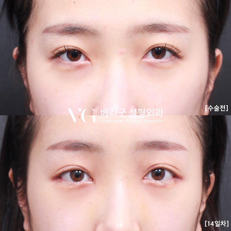 강남역 이마거상 전후, 베리굿성형외과💖 관련 이미지 3