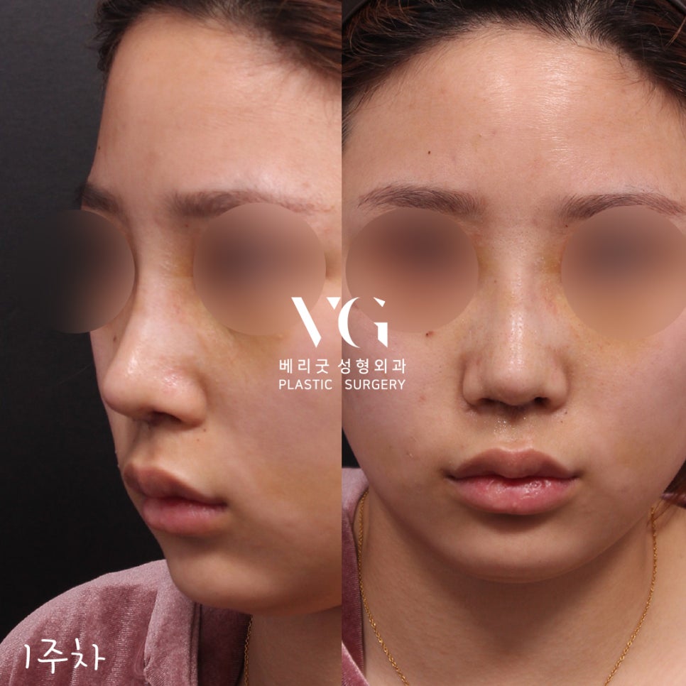 직반코성형전후💖베리굿성형외과 관련 이미지 3