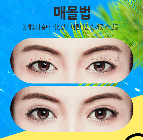 눈성형잘하는곳 내게 맞는 눈매라인에 맞게 관련 이미지 4