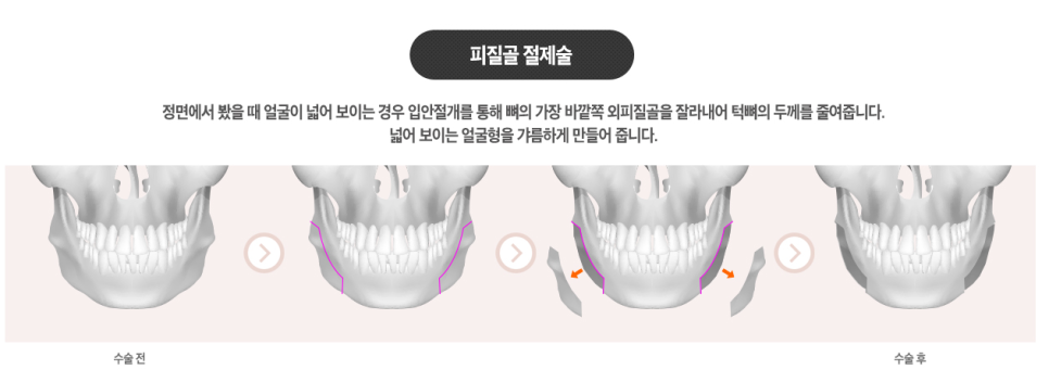 베리굿&hearts;얼굴에 찰떡! 베리굿 사각턱축소 관련 이미지 4