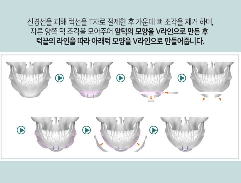 턱끝V라인으로 갸름한 얼굴라인 될수있다? 관련 이미지 3