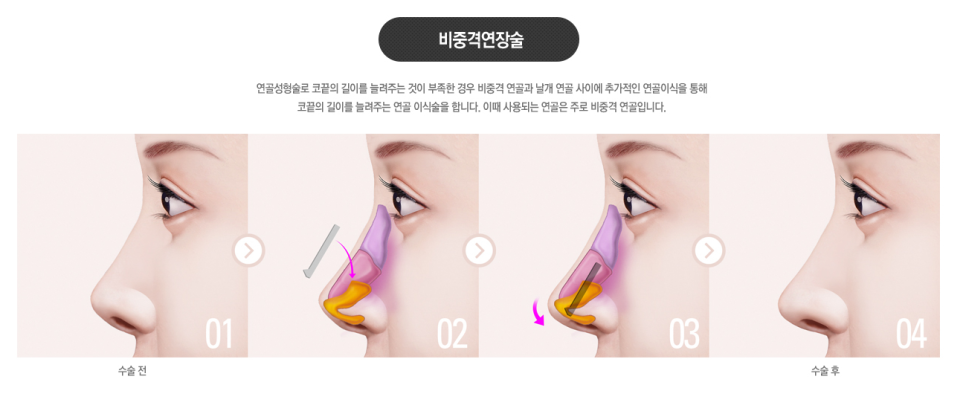 짧은 첫코성형도! 구축된 코재수술도! 베리굿성형외과✨ 관련 이미지 6