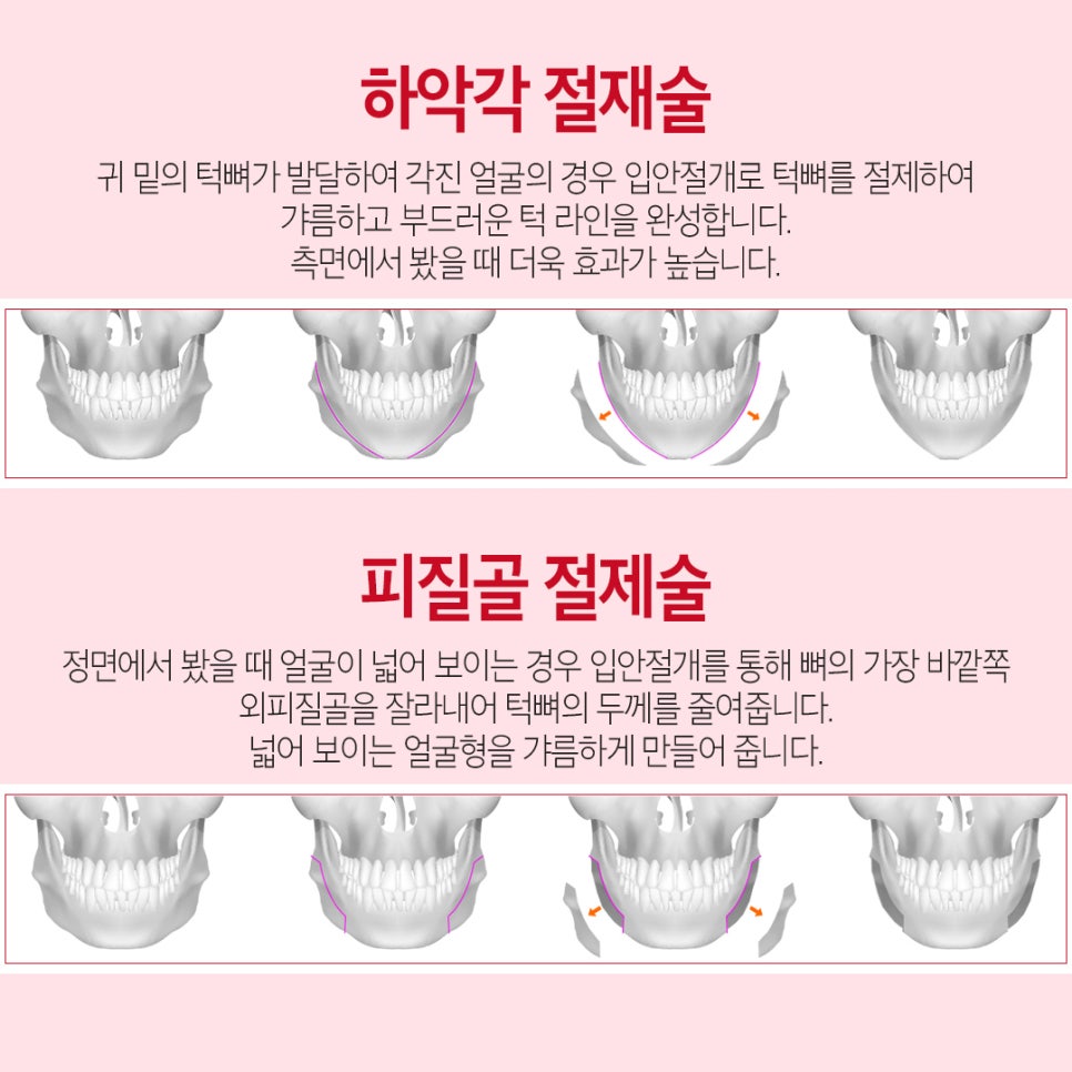 강남역 윤곽성형 베리굿성형외과👨&zwj;⚕️안면윤곽 전문의 임영민대표원장님💖 관련 이미지 3