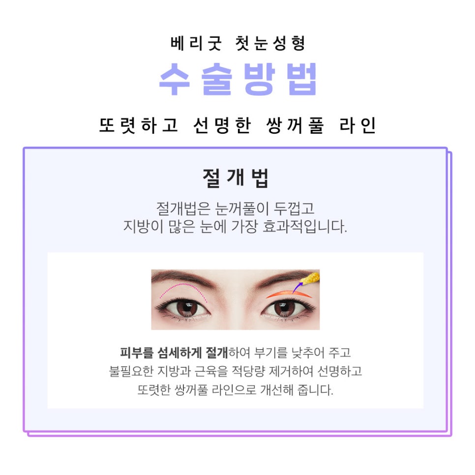 아름다운 당신을 위한 베리굿의 첫눈성형 관련 이미지 4