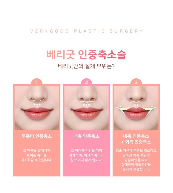 긴 인중이 짧아지면 달라지는 인상, 강남역 인중축소술 효과 총정리 관련 이미지 5