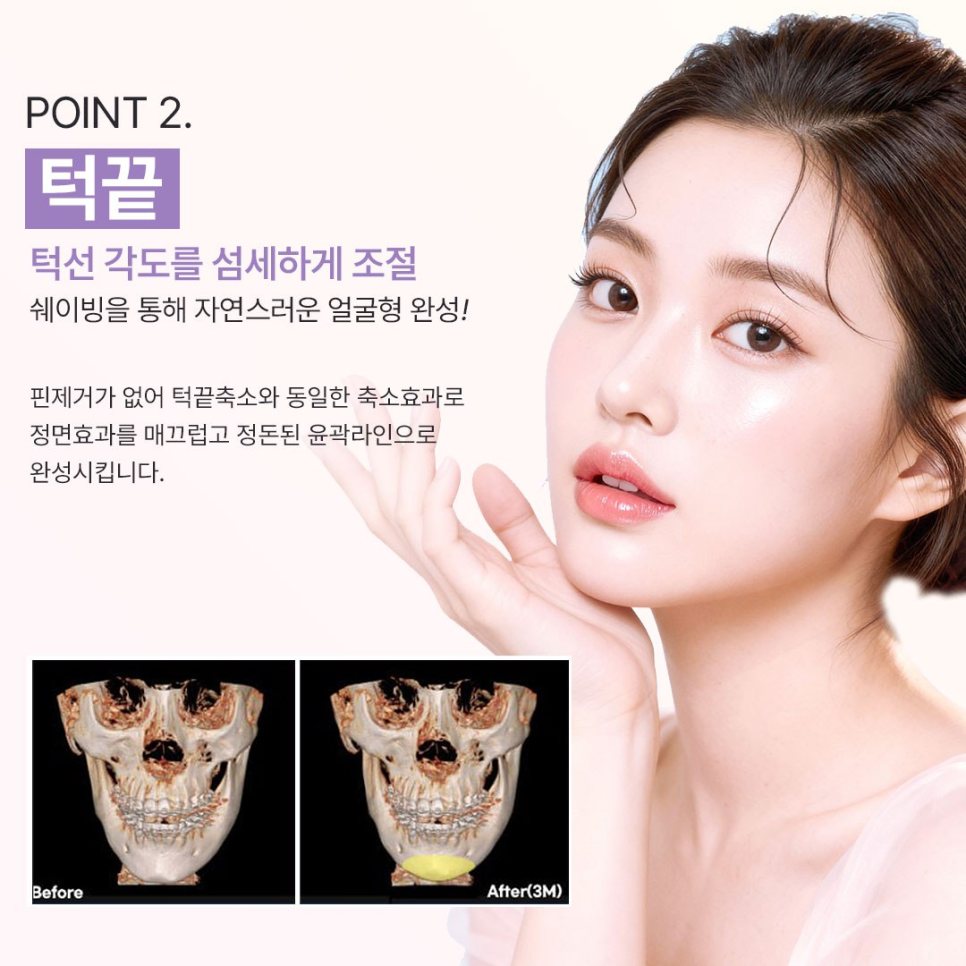 연예인 얼굴형 관리법 ? 요새 트렌드인 베리굿 성형외과 핀없는 안면윤곽 관련 이미지 4