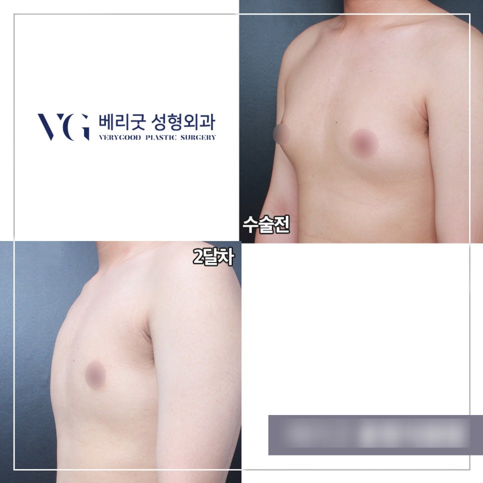 남자여유증수술 베리굿성형외과👨&zwj;⚕️ 관련 이미지 7