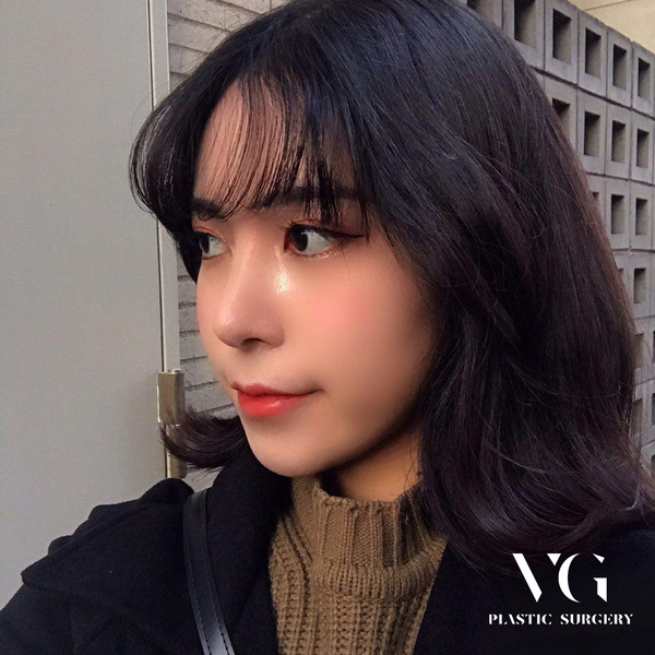 매부리코, 코성형 유형에 맞게 수술하자 관련 이미지 1