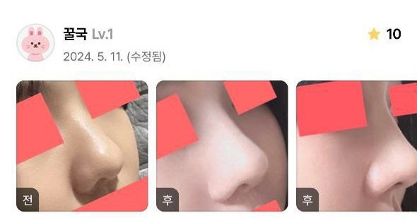 첫코수술 절골 기증늑연골 비중격교정술 하비갑개절제술 베리굿성형외과 코수술 후기 관련 이미지 4