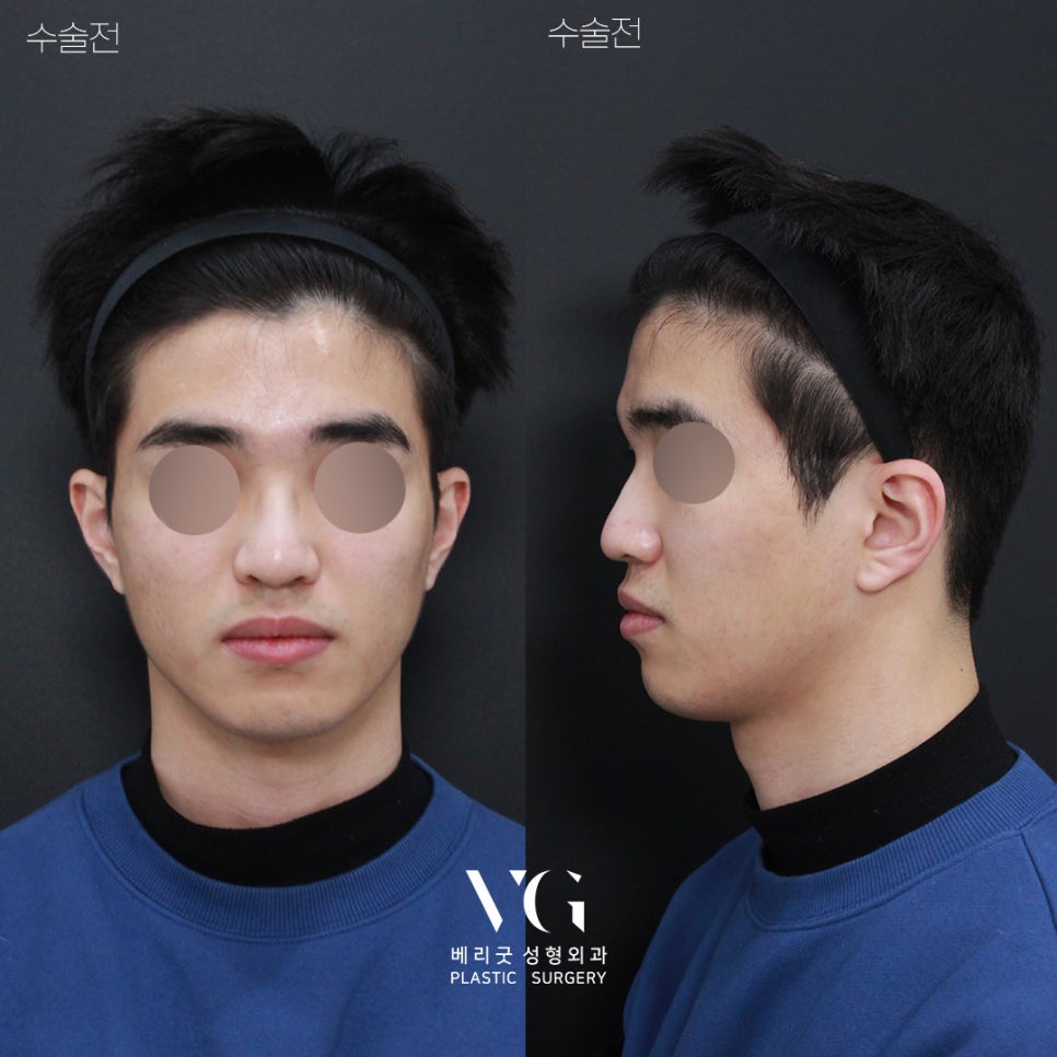 [ 베리굿성형외과 ] 안면윤곽 3종 Special한 REAL 전후비교 관련 이미지 1