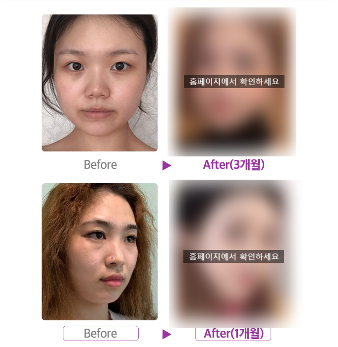 각진얼굴형 얼굴작아지는법 관련 이미지 8