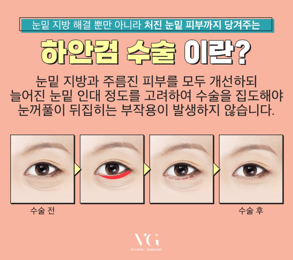 10년은 젊어보이는 동안성형 베리굿 애교하안검❣ 관련 이미지 3