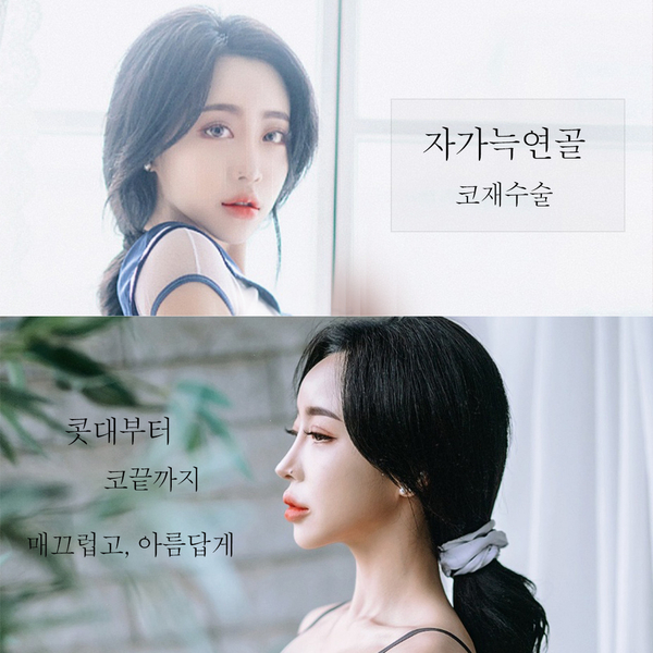 늑연골코재수술, 안전하고 아름답게! 관련 이미지 1