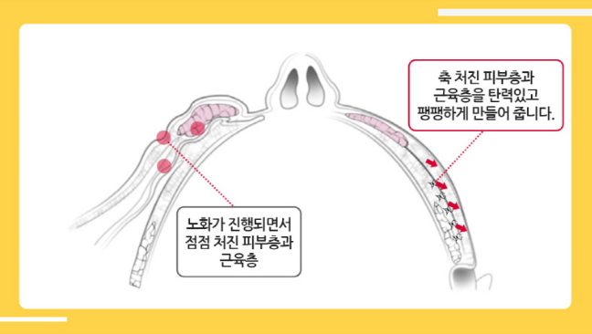 안면거상술 확실한 리프팅효과 관련 이미지 3