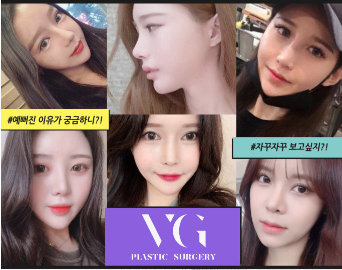 베리굿성형외과 동안페이스! PRP미세지방이식 결과를 확인해봐~ 관련 이미지 7