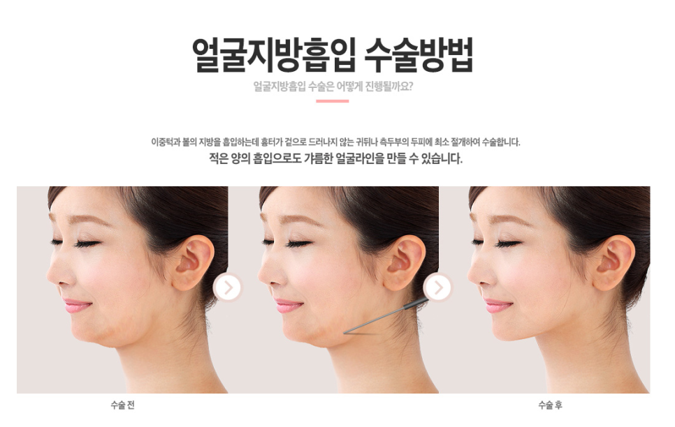 베리굿 얼굴지방흡입 전후💖밖에서 언제까지 마스크 쓸래? 관련 이미지 5