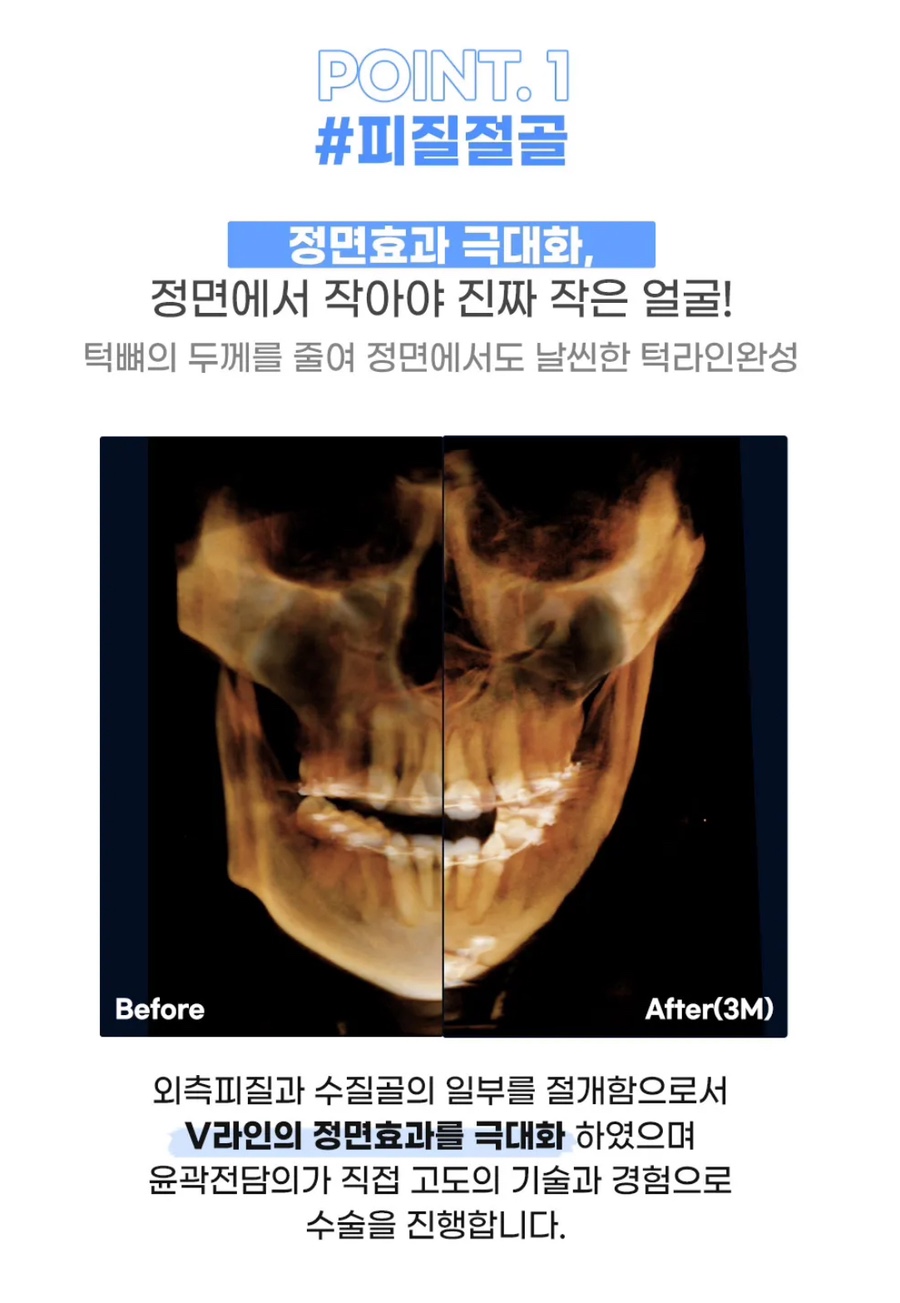 회복기간 빠르고 붓기적은 안면윤곽 원한다면 , 연예인 핀없는 안면윤곽 관련 이미지 8