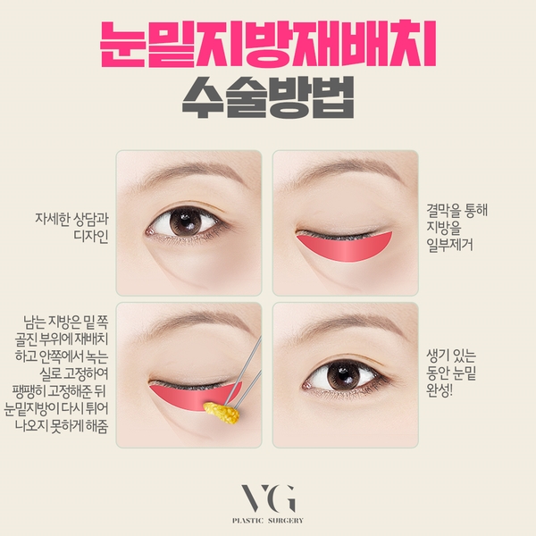 눈밑지방재배치잘하는곳 어떻게 찾을까? 관련 이미지 4