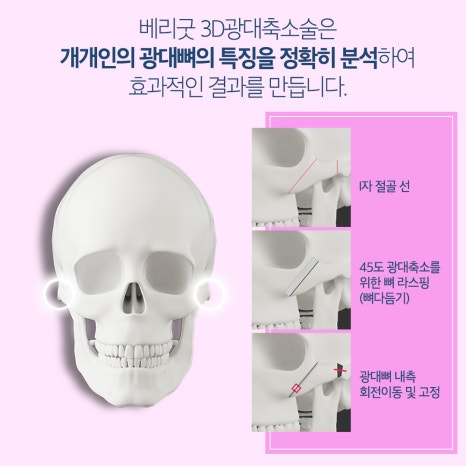 안면윤곽3종으로 매끄럽게 만족스러운 결과 관련 이미지 6