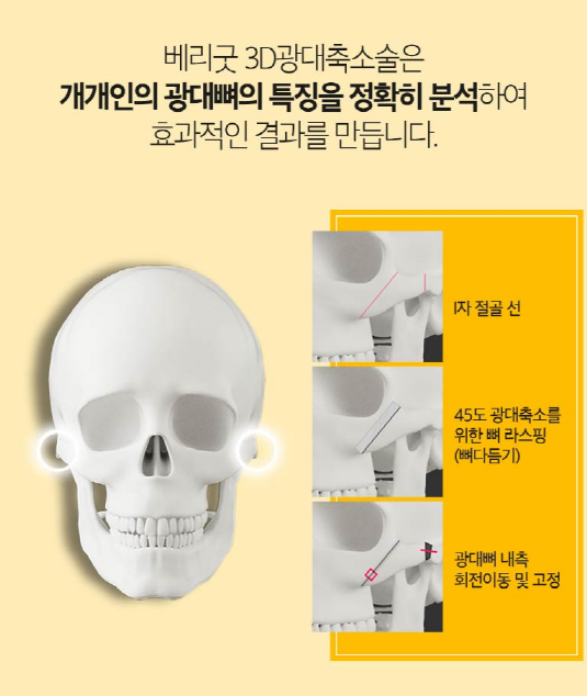 안면윤곽으로 작고 갸름한 얼굴형 만들자! 관련 이미지 9
