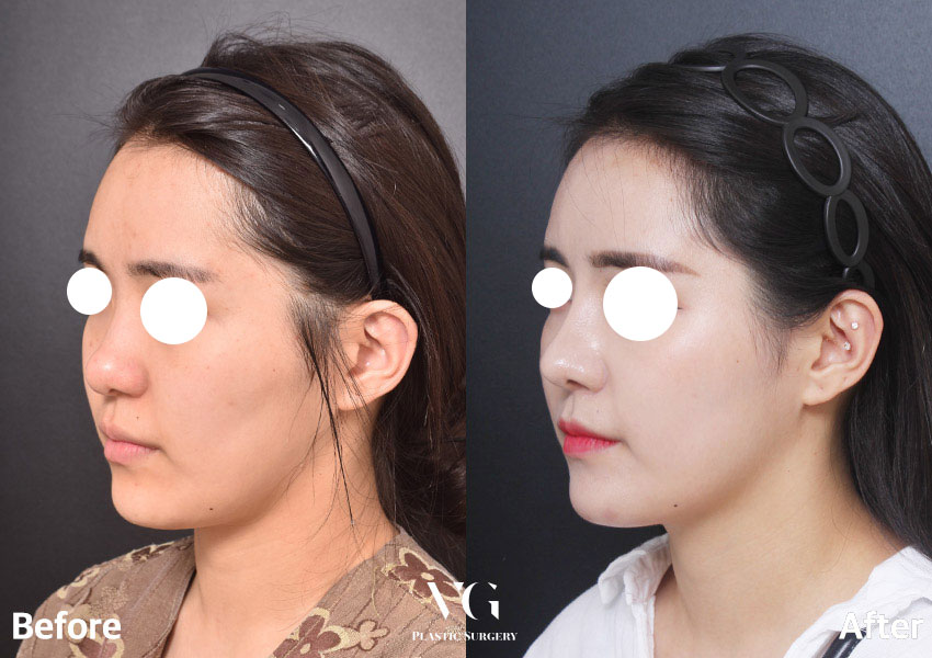 [ 베리굿성형외과 ] 베일듯한 코라인 베리굿 복코 찐 전후비교 관련 이미지 7