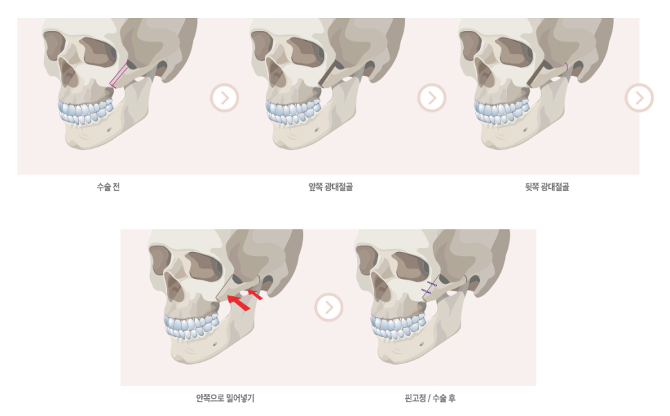 안면윤곽 3D-CT로 뼈구조부터 확인하고 관련 이미지 4