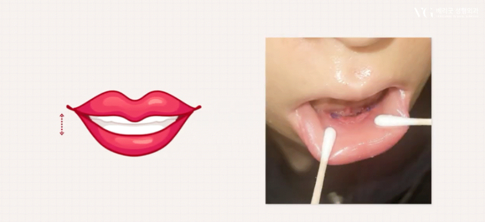 강남역 마녀턱 턱끝거상 , 리프팅원인 수술방법 총정리 관련 이미지 11