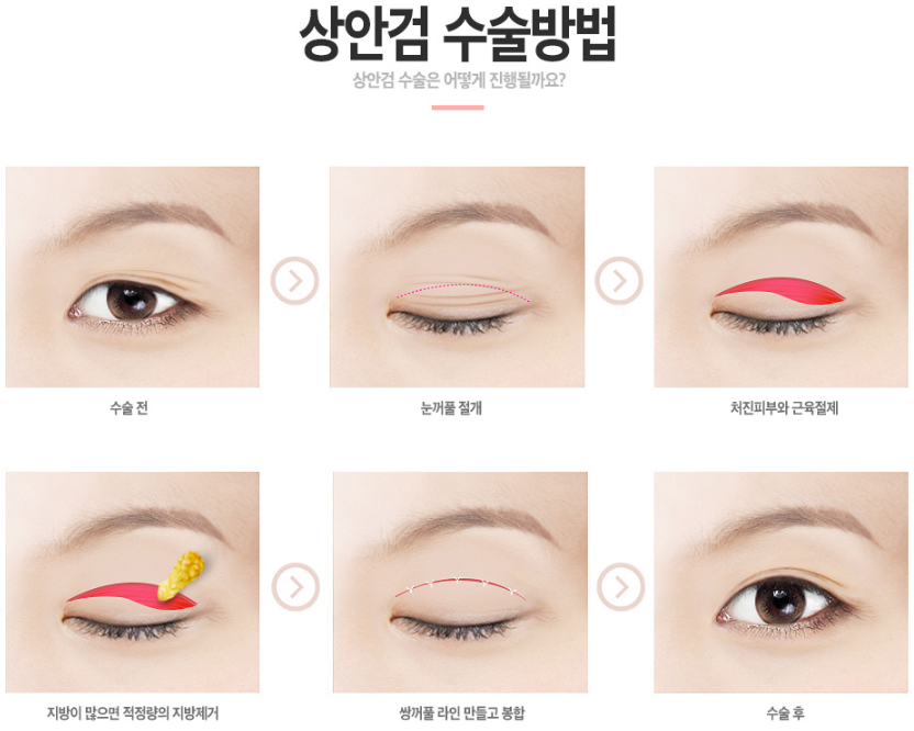 베리굿성형외과 중년 눈성형 (상안검), 그때 그 시절 나의 리즈로 #베리굿성형외과 #임영민원장님 관련 이미지 5