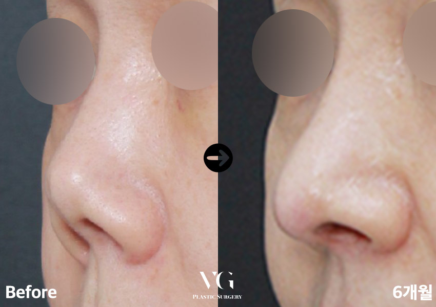 실패한 구축코재수술 베리굿에서 👨&zwj;⚕️✨ 관련 이미지 10