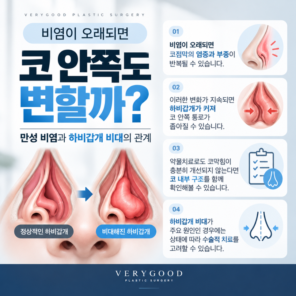 비염이 오래되면 코 안쪽도 변할까? 만성 비염과 하비갑개 비대의 관계 관련 이미지 2